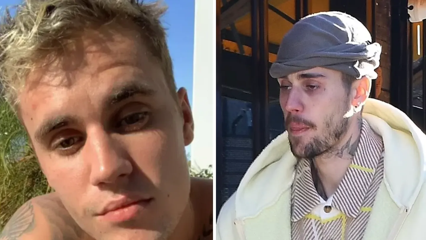 Justin Bieber Drastic Transformation Raises Concerns Amid Marriage Troubles