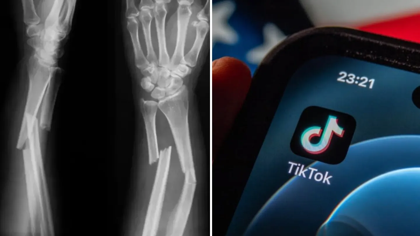 Bizarre Theory Explains Why Some People Have Never Broken a Bone