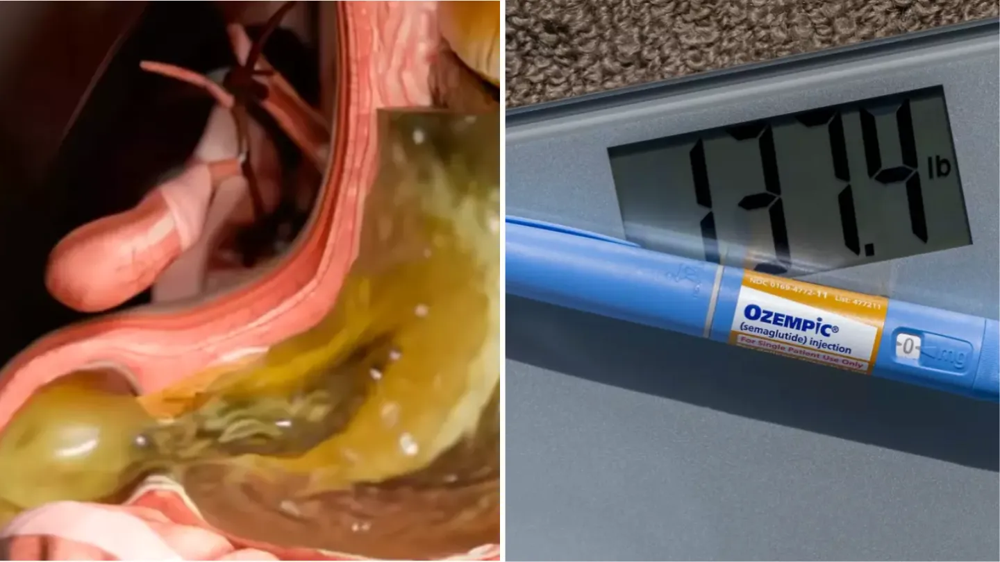 Celebrities Reveal Side Effects of Ozempic as Body Simulation Exposes Truth